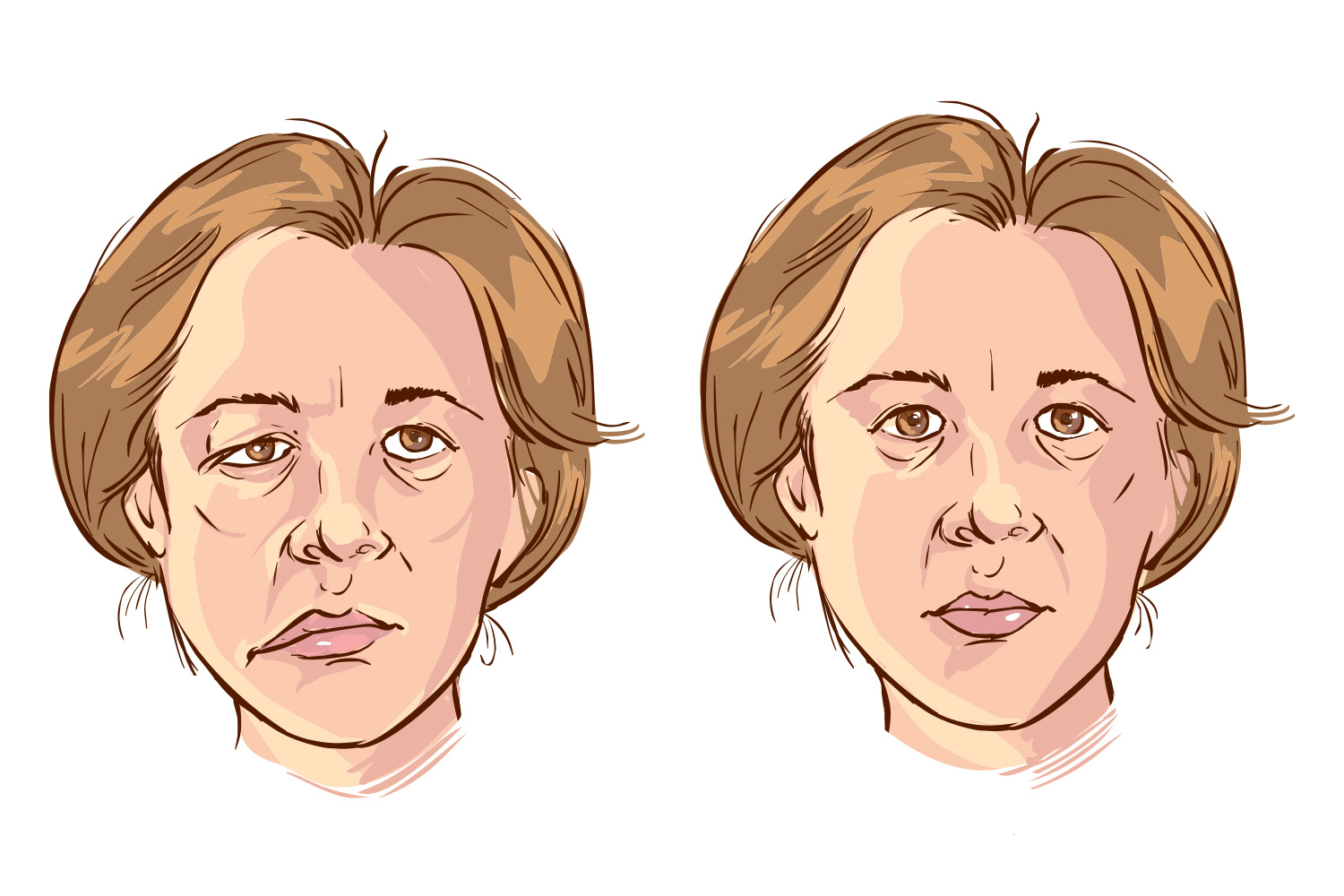 bell's palsy